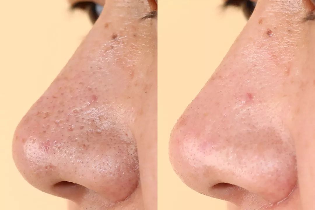 别再挤黑头了一贴一撕陈年黑头连根拔起毛孔瞬间干净了