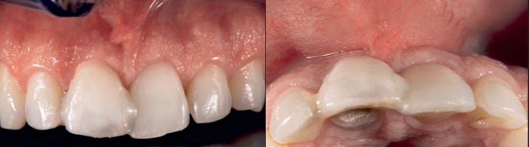 改良龈瓣设计结合pla膜及βtcp骨替代材料行美学区水平骨增量的疗效