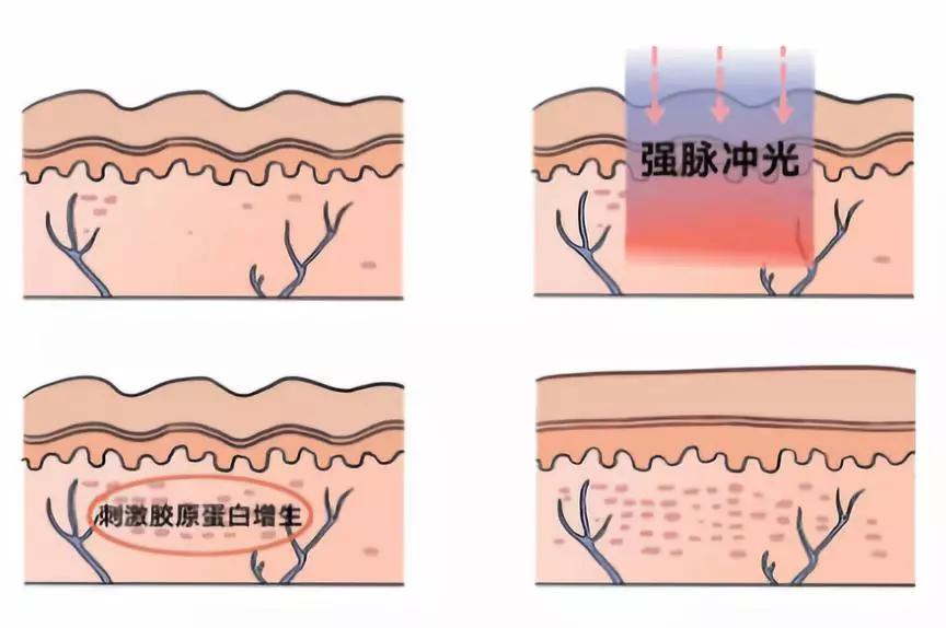 强脉冲光治疗仪和调q激光皮肤治疗仪比较