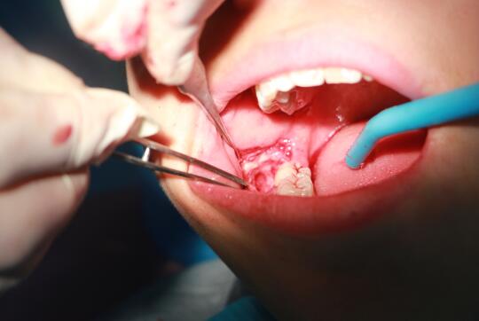 关于这些种牙谣言90的人都相信过其中有你吗