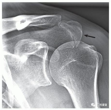 肩关节解剖与影像的联系