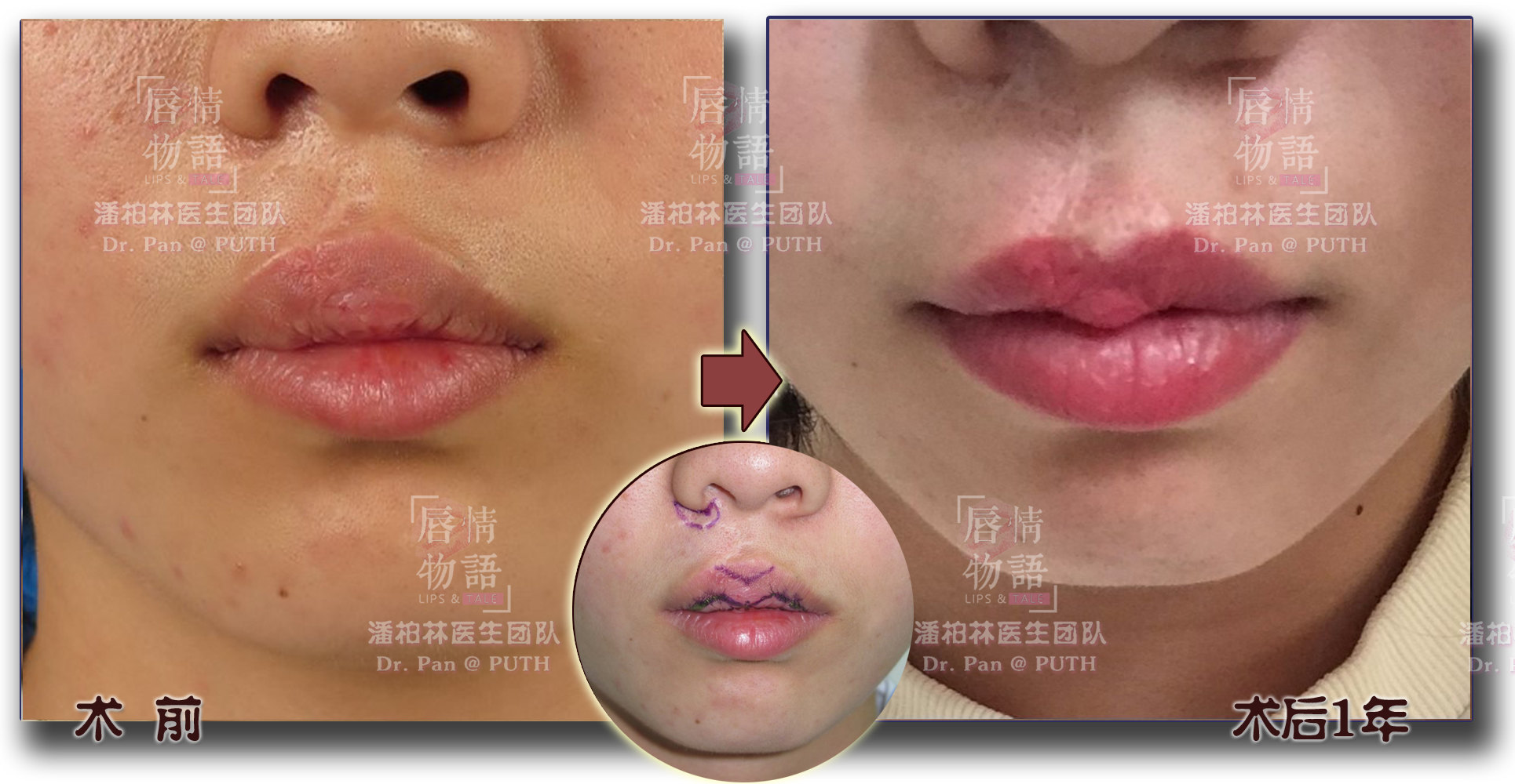 唇裂修复术后继发畸形的序列治疗 (原创)