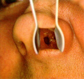 鼻中隔偏曲鼻中隔疾病:鼻中隔偏曲,糜烂,溃疡或穿孔等.