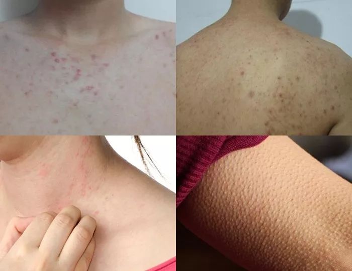 用它洗澡螨虫没了三天还能散发迷人体香