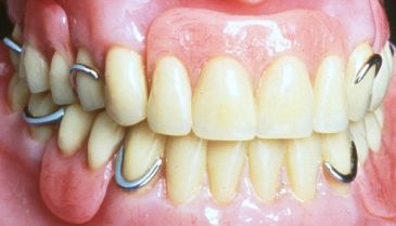 金赛义齿维他灵支架修复病例