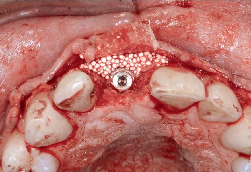 改良龈瓣设计结合pla膜及βtcp骨替代材料行美学区水平骨增量的疗效