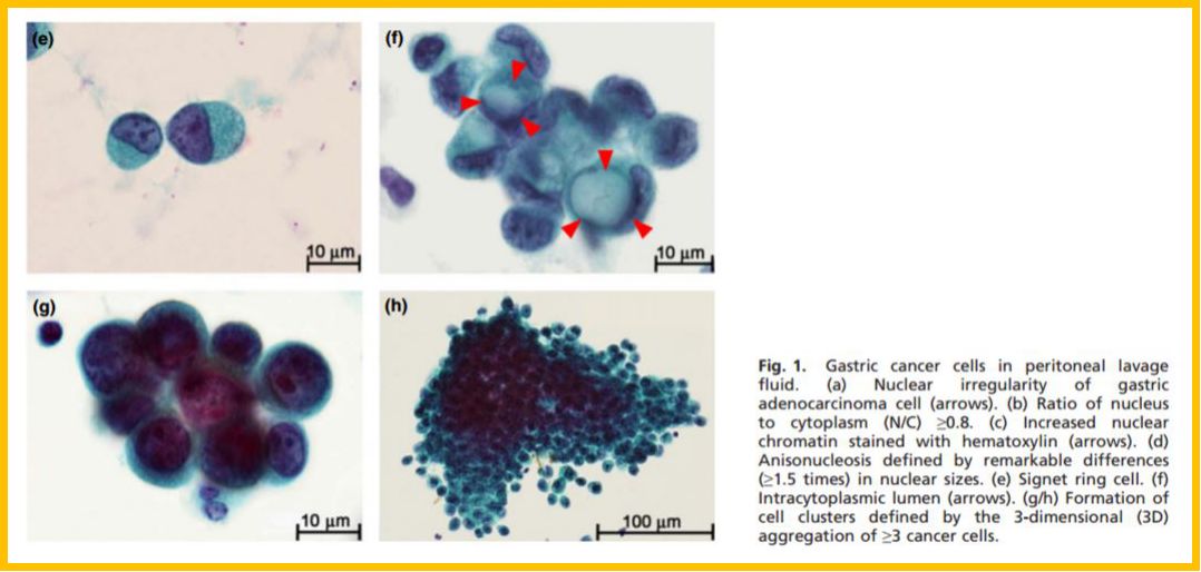 王亚农教授腹腔镜分期在选择Ⅳ期胃癌转化治疗中的意义