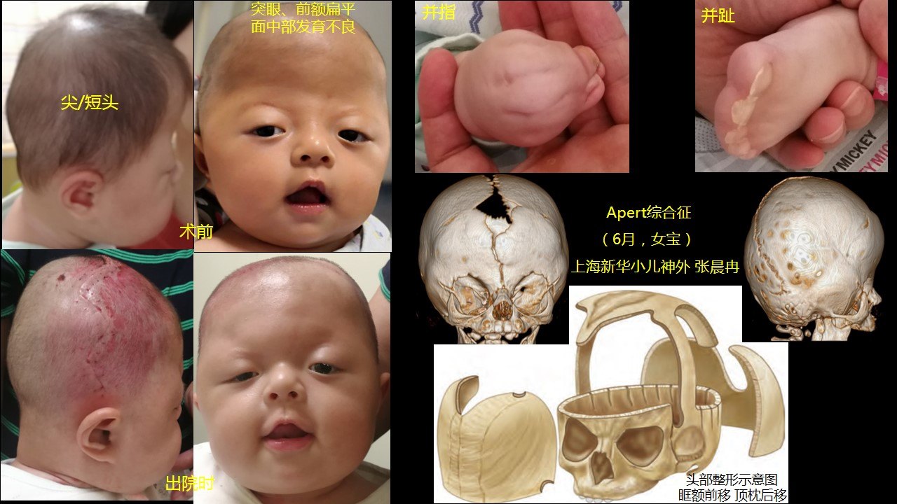 apert综合征原创