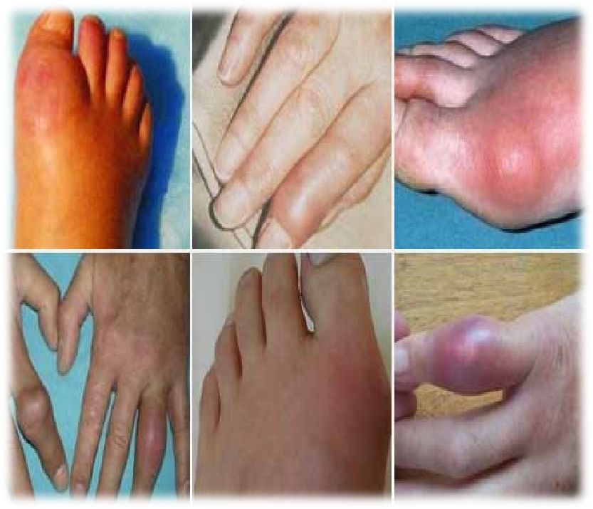 别以为痛风是老年人的事儿年轻人也要小心了