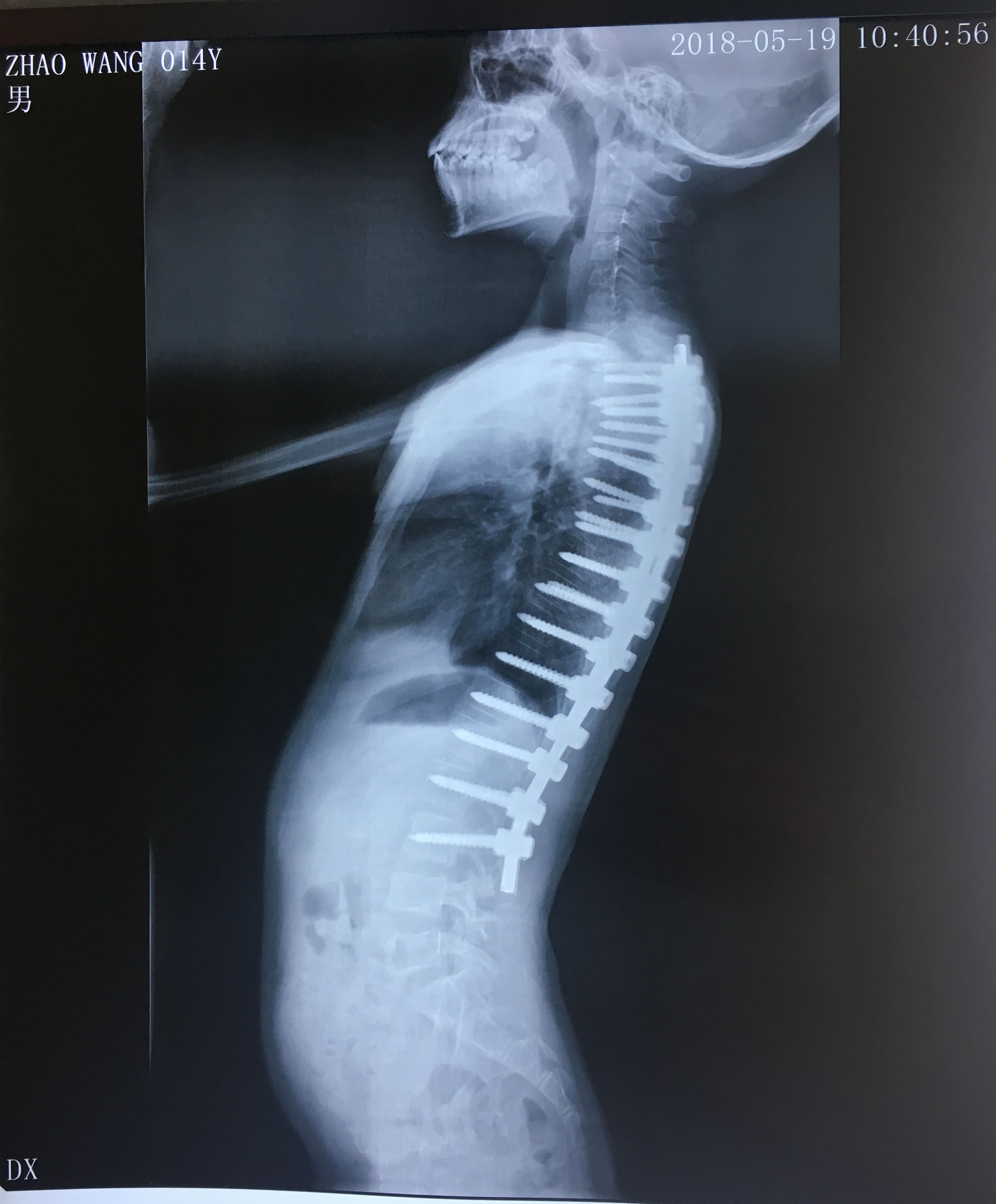 原创神经纤维瘤病型脊柱侧弯脊柱外科治疗后会复发吗