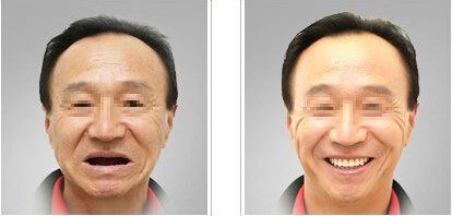 你的牙齿有缺失吗关于种植牙的那些事儿