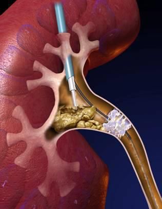输尿管软镜优势:输尿管软镜完全经人体自然通道完成手术,无术后出血