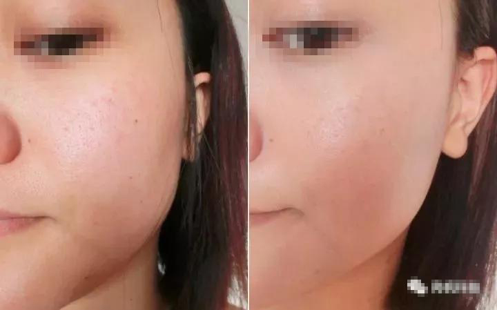 一分钟看懂涂抹水光无针水光水光针的区别