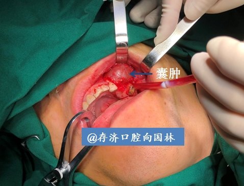 牙齿残根引起大型颌骨囊肿原创