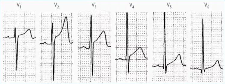 细数st段抬高的n种原因,你可清楚?
