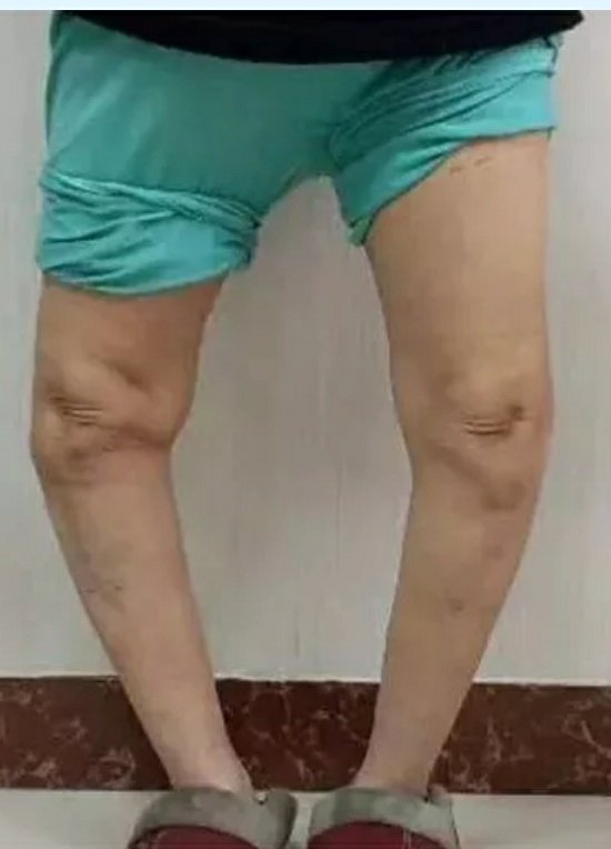 重度内翻膝,o型腿.x线前可见关节磨损,骨赘增生,关节变形