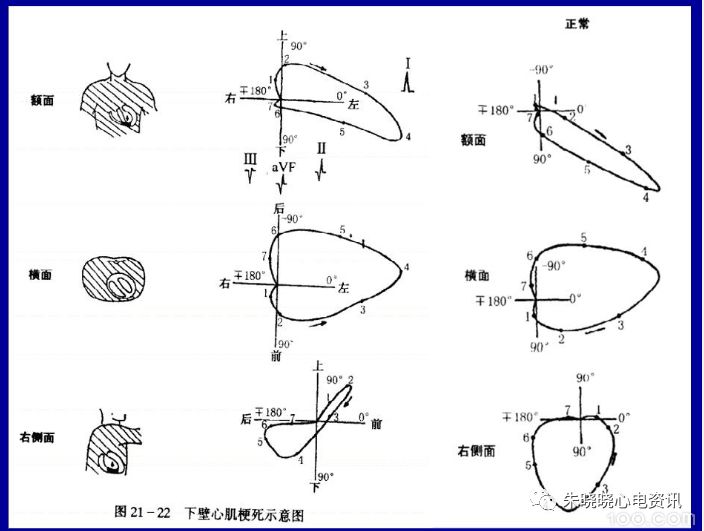 【yy语音】潘二明老师:心肌梗死的心电向量图特征2019