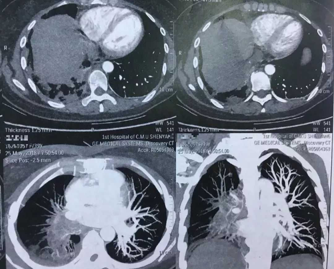 低热肺部阴影充盈缺损血栓以外还有哪些其它原因值得探寻