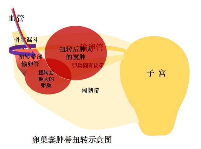 阑尾和右侧卵巢位置图图片