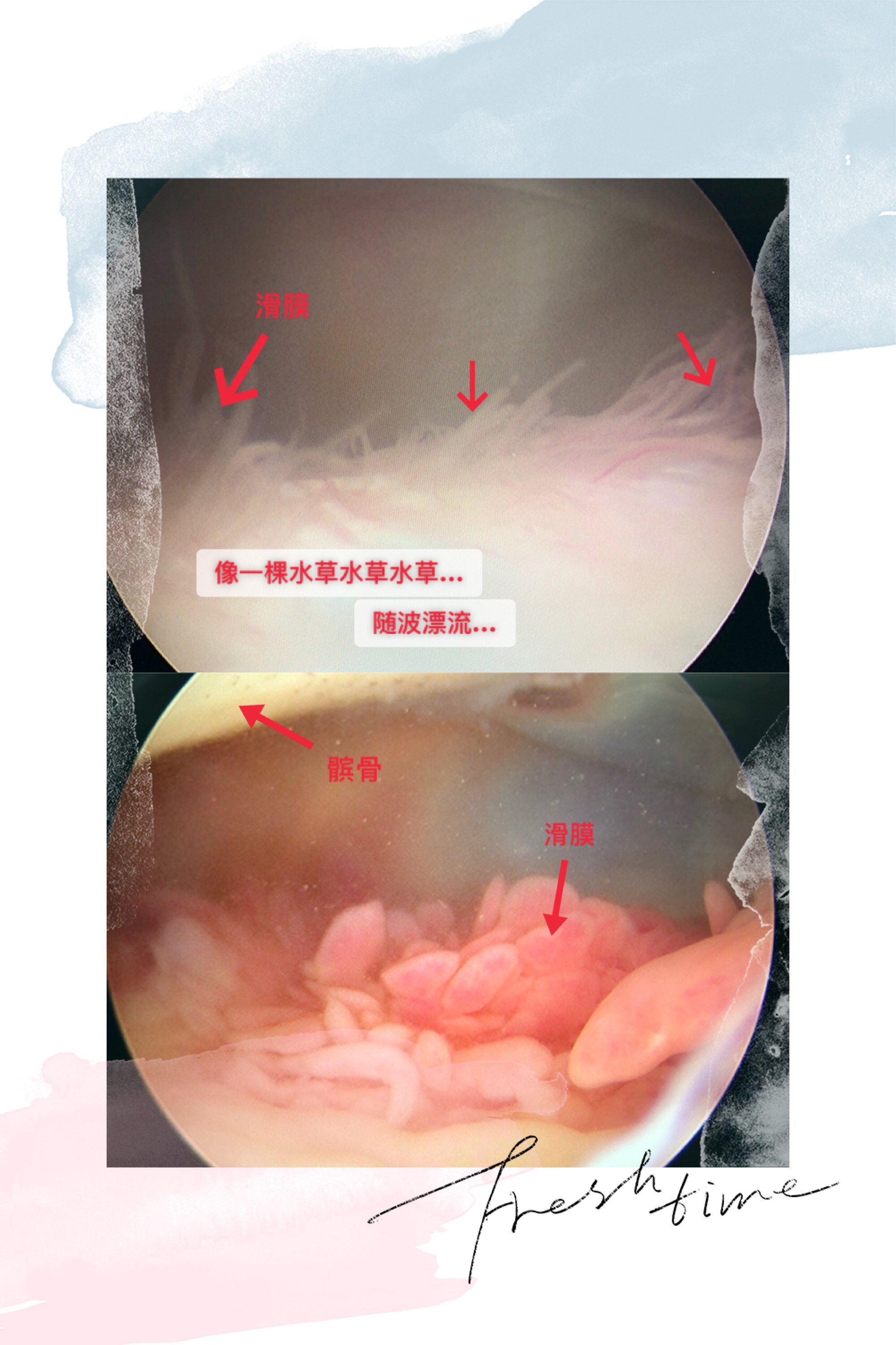滑膜炎镜下表现 (原创)_膝关节