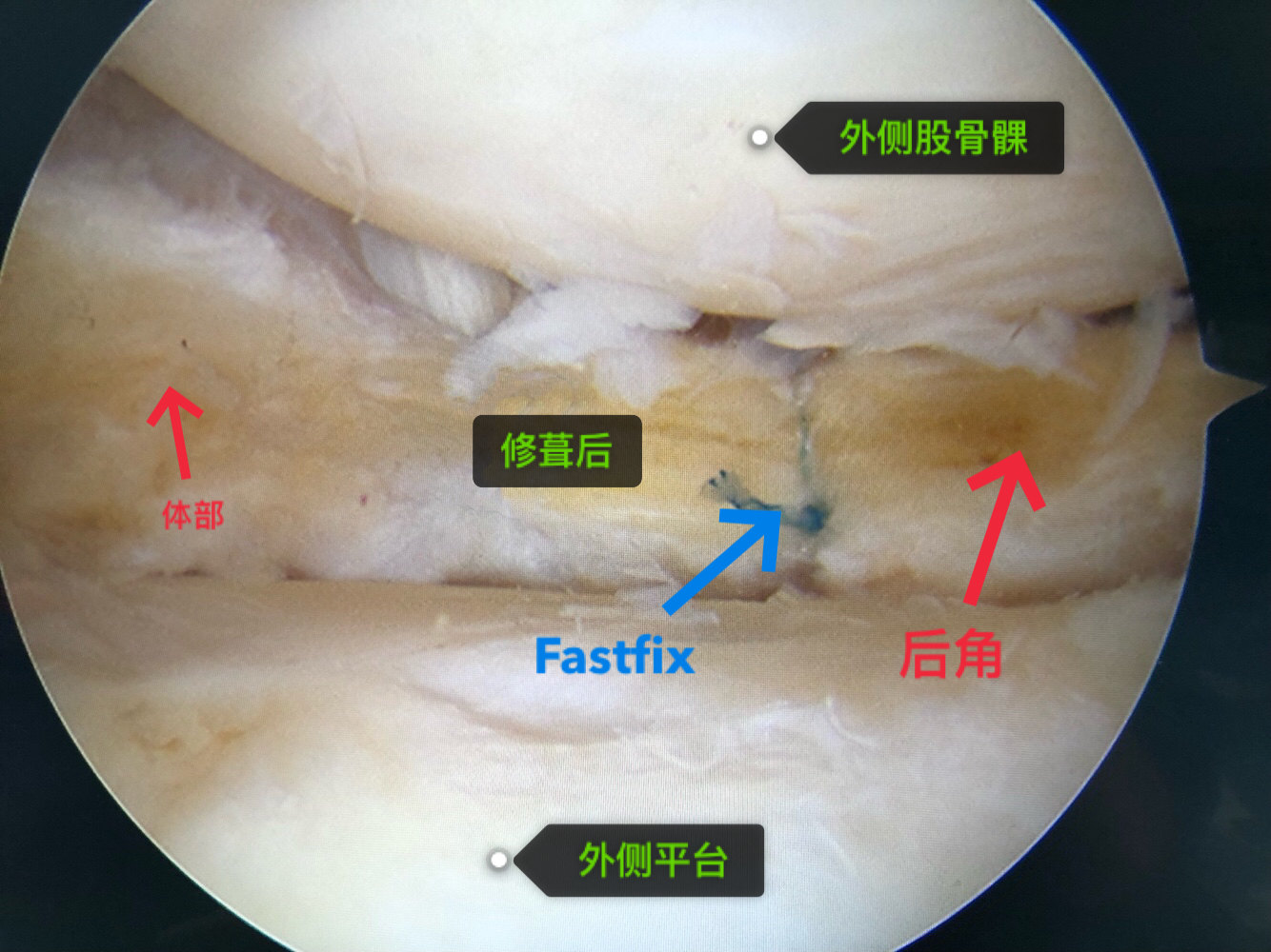 外侧半月板损伤缝合