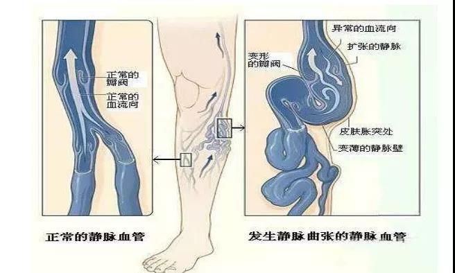 为什么会有静脉曲张图片