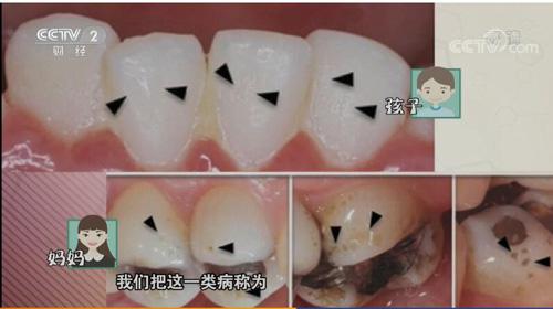 的因素相对复杂,单纯从牙齿来说,常见的遗传性疾病有牙本质发育不全