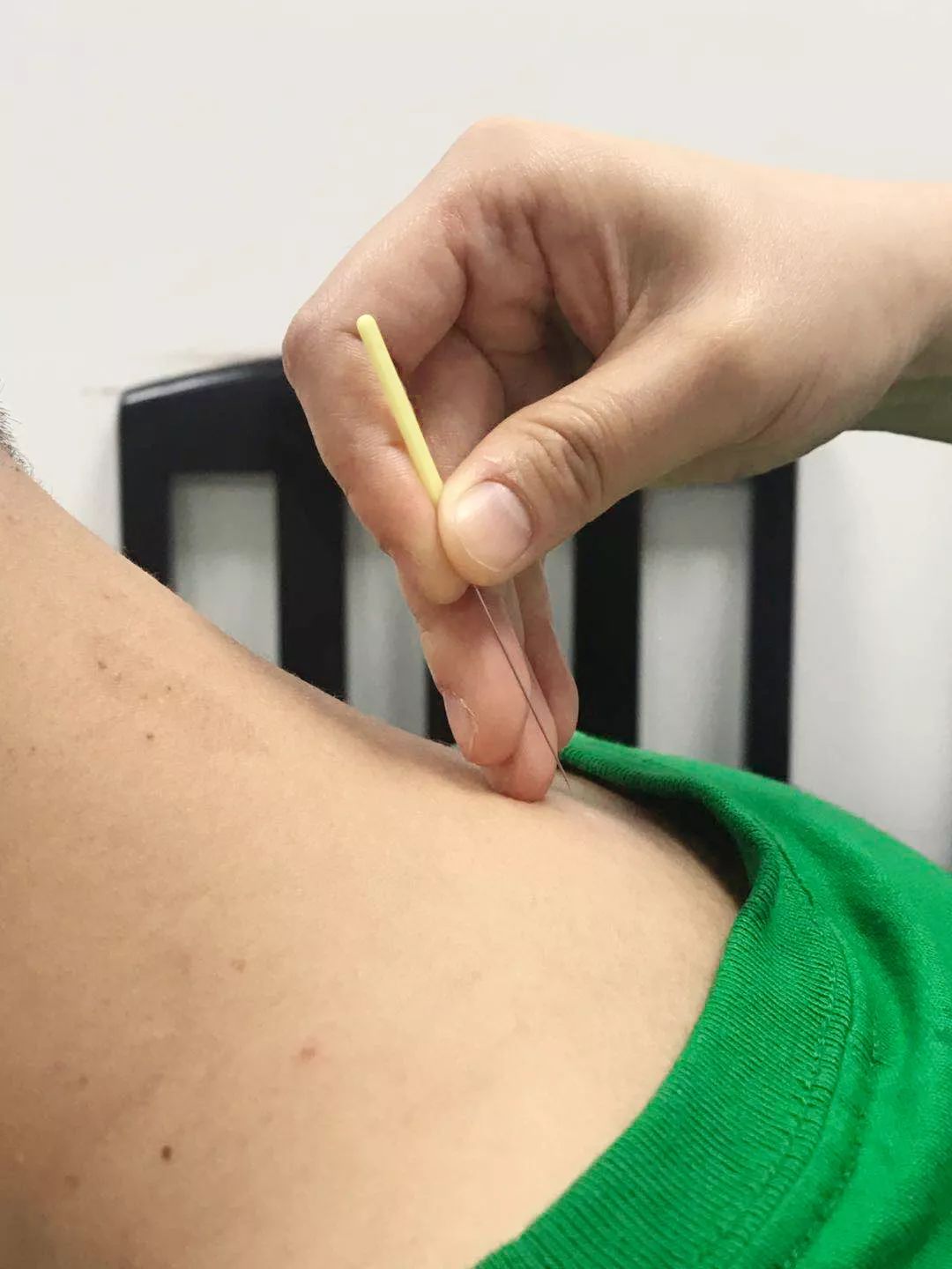 刃针疗法:源于九针,以针为刀,辨证施治,微创速效艾灸疗法:陈艾搓绒,温