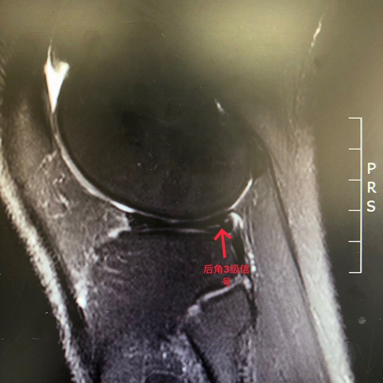 外侧半月板损伤缝合 (原创)_裂隙