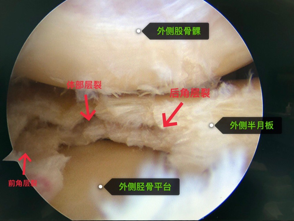 外侧半月板撕裂图片