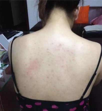 鸡皮肤后背有痘痘(后背长痘跟鸡皮一样是什么原因)
