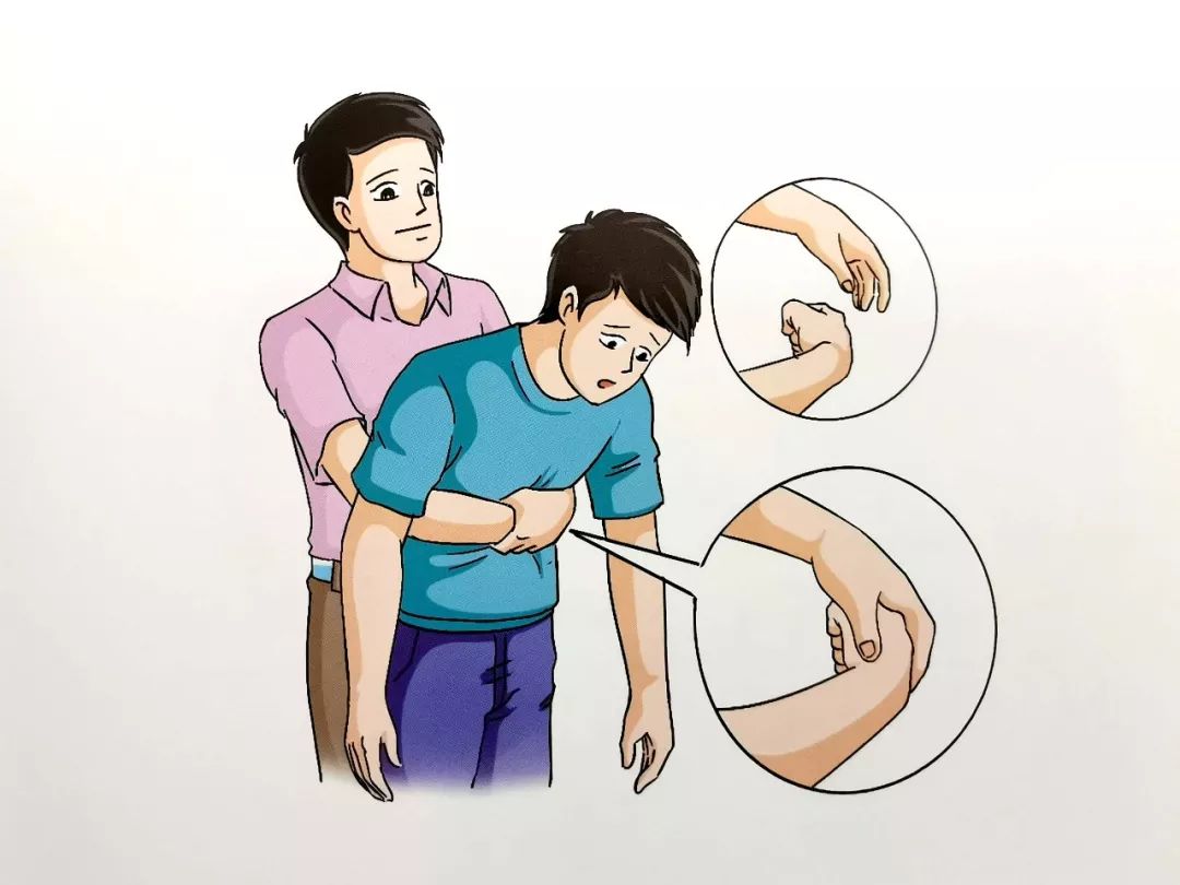 向上冲击5次,如果梗阻没有解除,继续交替进行5次背部叩击