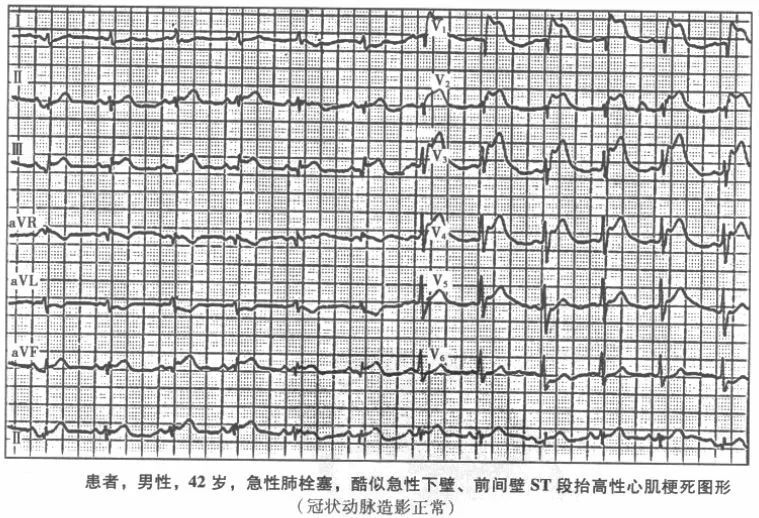 尽管st段抬高是判断心梗的重要特征,但许多其他临床原因均可引起st段