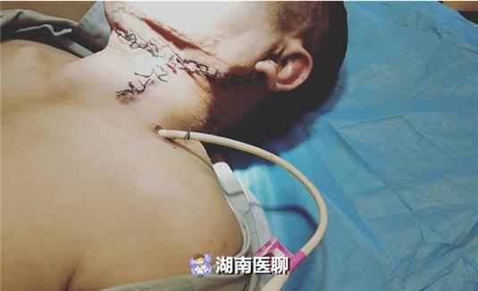 舌头活动受到限制,今年3月,在当地医院进行肿块穿刺检查为淋巴结转移