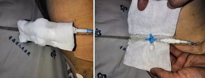 传统临床胸腔或腹腔引流中三通护理实图1创新点:a此医用导管固定切口