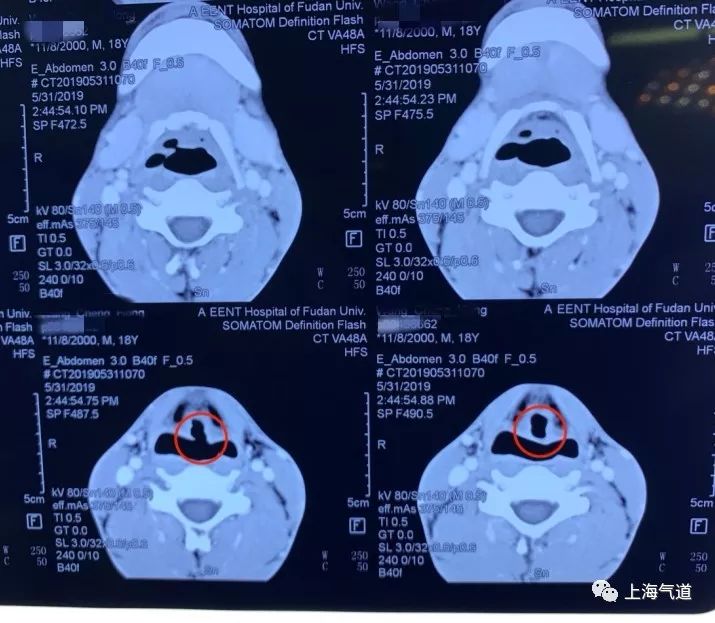 局麻气切还是清醒插管?这,是一个问题_声门