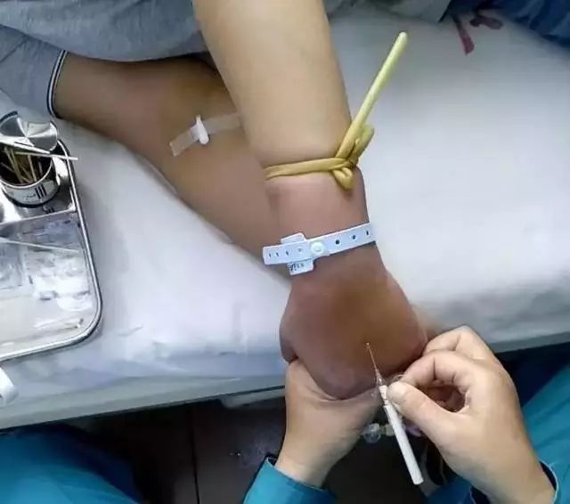 留置针穿刺有技巧一针见血