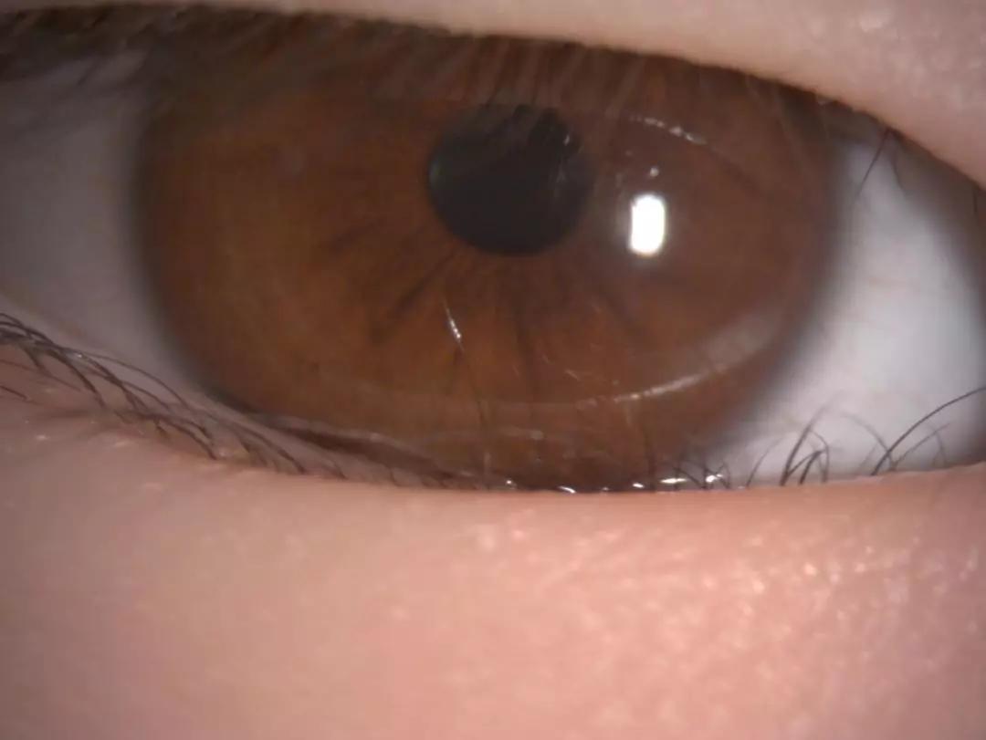 绿鸽爱眼工作室 | 眼睑内翻与倒睫的孩子如何保护眼睛_眼睫毛