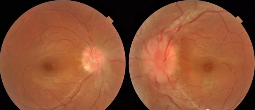 视乳头边界均欠清,但水肿程度不一致:右眼轻度隆起,颜色白,动脉血管