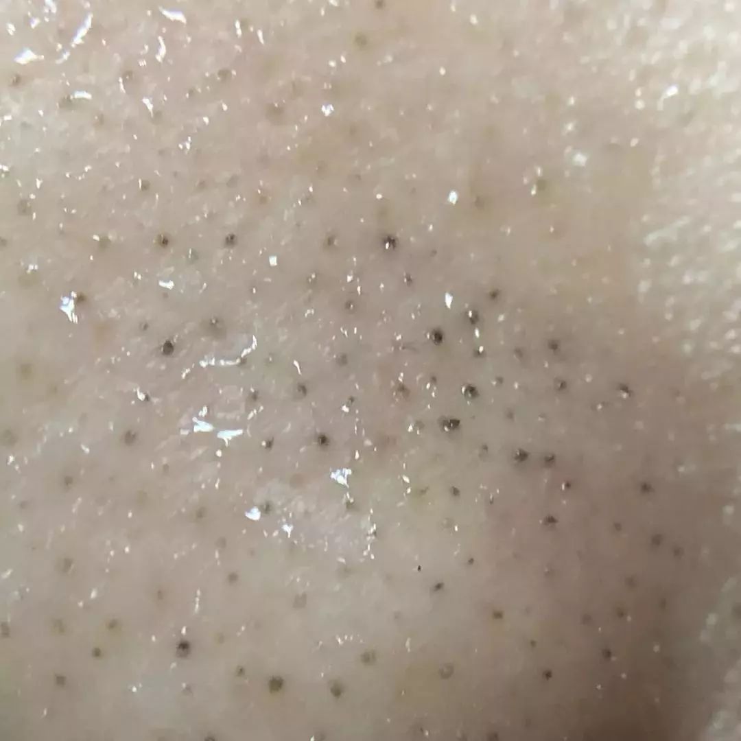 简单易学!黑头一颗颗被拔出,皮肤秒变奶白豆腐肌
