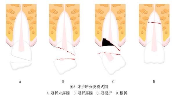 待治療結束後再修復缺損的牙體;牙齒受外力打擊所引起的鬆動,移位