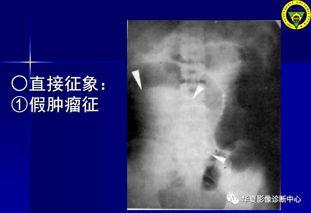 如何用影像评价绞窄性肠梗阻