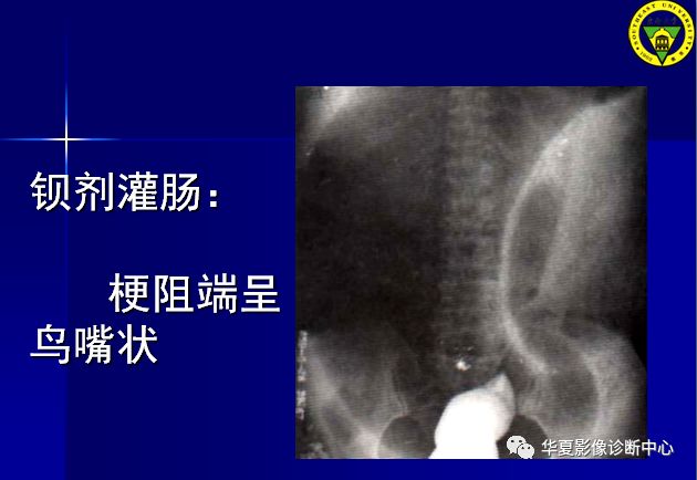 如何用影像评价绞窄性肠梗阻_来源