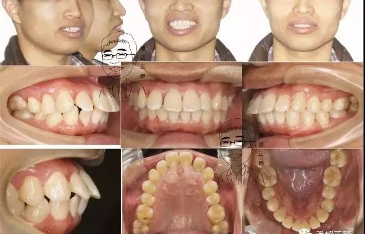 上前牙覆盖下前牙的水平距离>3mm以上,有的仅表现为牙齿的过度倾斜