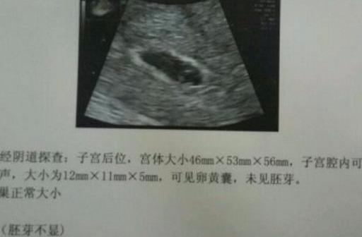 怀孕8周女孩孕囊图片图片