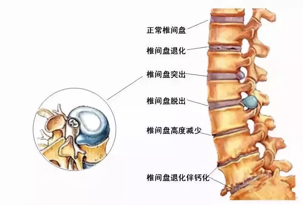 腰间盘突出复位图解图片