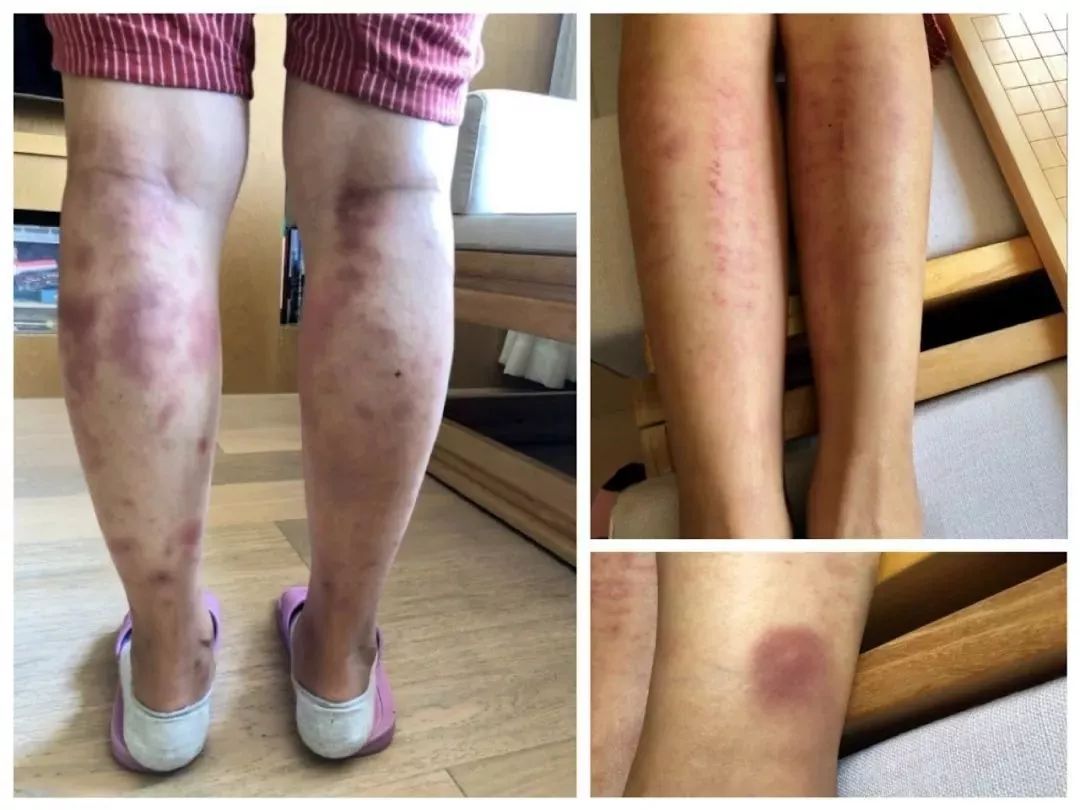 皮下都是「細沙」的感覺右小腿出痧相對多,也是肝經,脾經疼,第一板