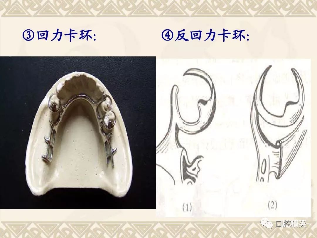 义齿卡环的种类图片图片