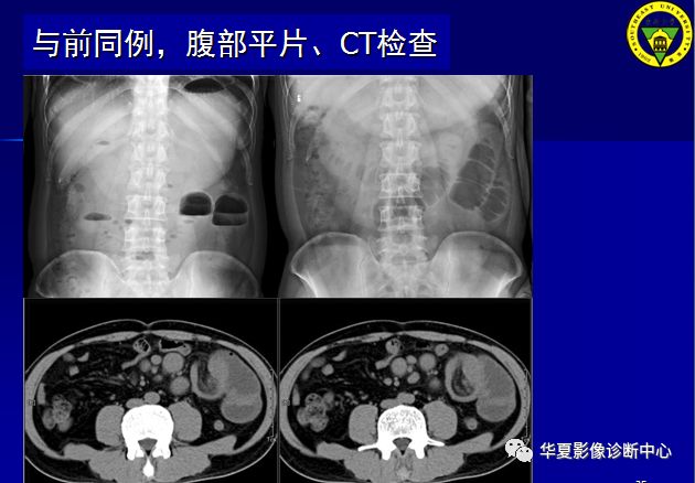 如何用影像评价绞窄性肠梗阻