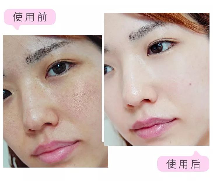 使用虞美人前后肌肤对比毛孔干净:就会收小,皮肤紧致有光彩.